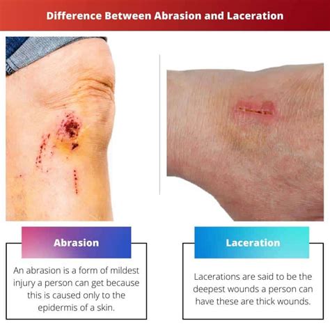 maceration vs laceration.